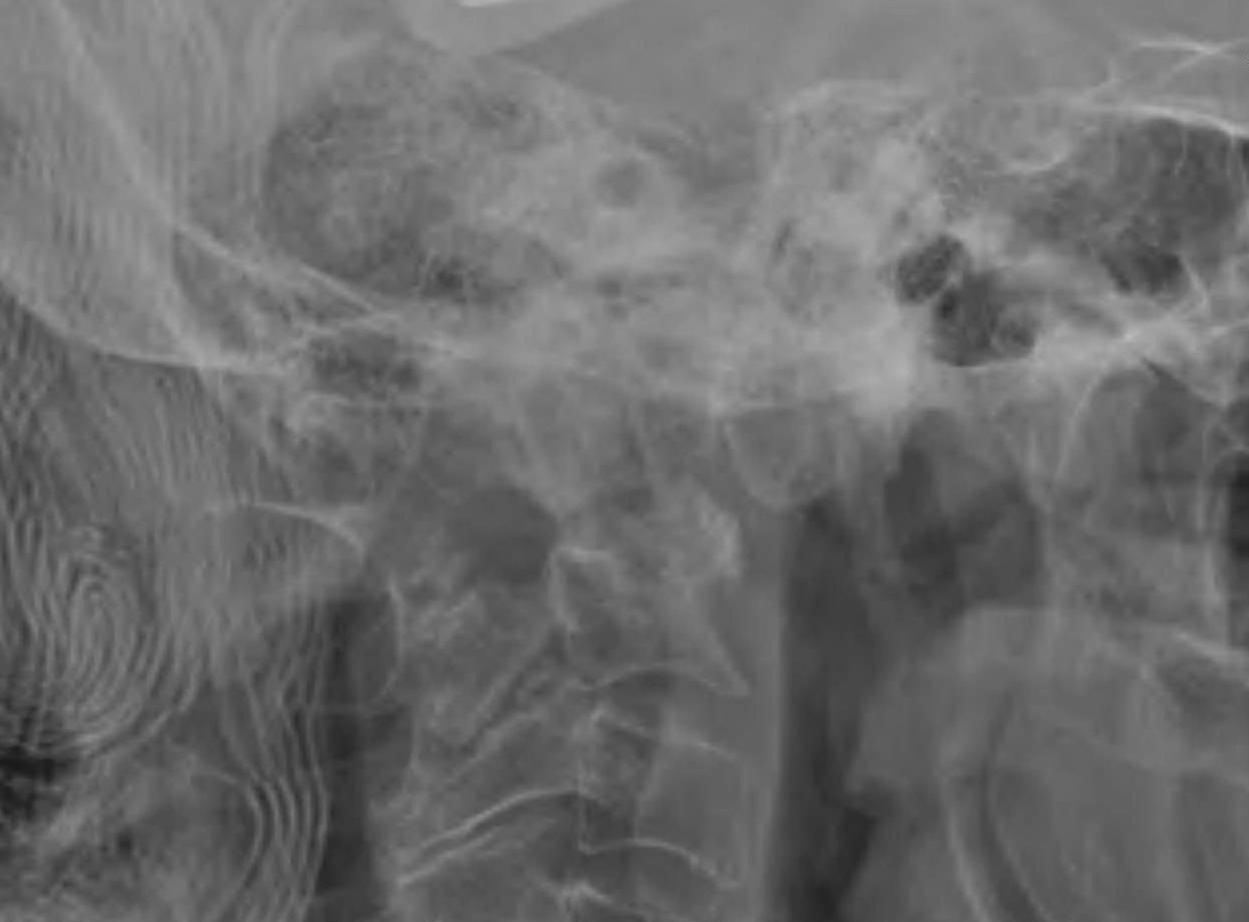 Superior Migration Ondontoid Lateral Xray Close Up